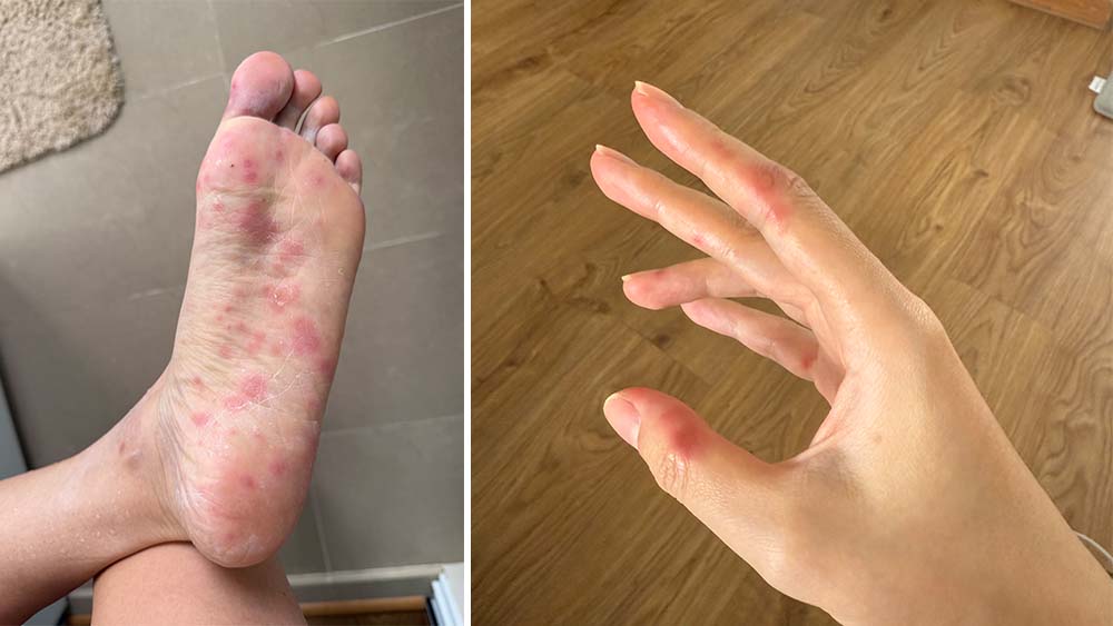Hand, foot, and mouth disease (HFMD) is not just for kids.
